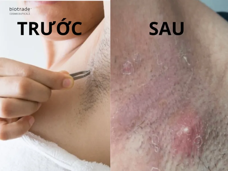 Hình ảnh minh họa trước và sau khi cạo nhổ lông nách 